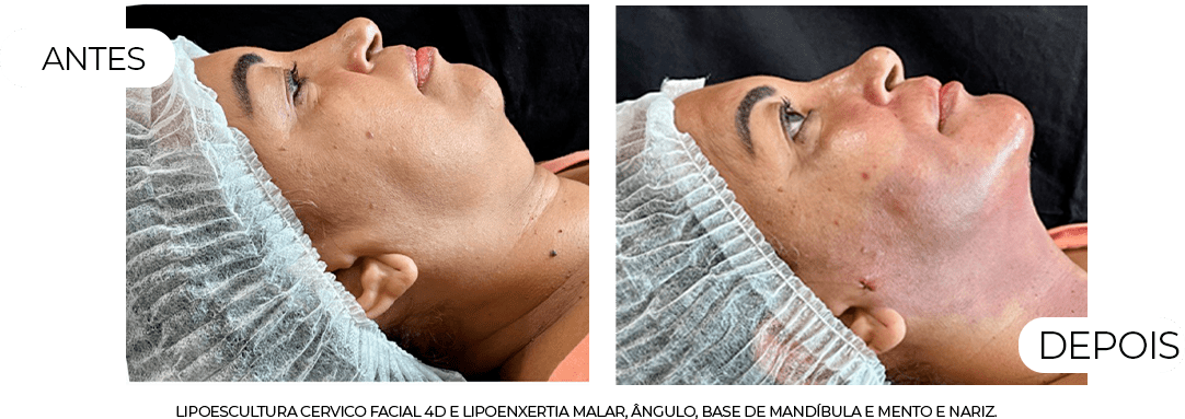 Lipoenxertia Curso online 2.0 – Sandro Valente